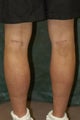 Men's Calf Augmentation