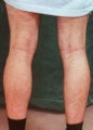 Men's Calf Augmentation