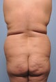 Body Liposuction