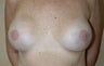 Breast Reconstruction