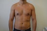 Gynecomastia - Male Breast Reduction