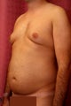 liposuction of abdomen and flanks of man from Los Angeles