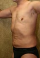 liposuction of abdomen and flanks of man from Los Angeles