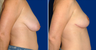 Breast Lift