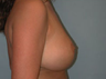 Breast Lift