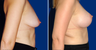 Breast Lift