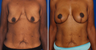 Breast Lift