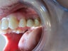 When a tooth fails, what should be done? An implant?