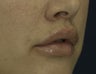 Lip Lift