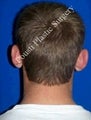 Ear Surgery (Otoplasty)