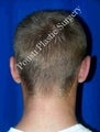 Ear Surgery (Otoplasty)