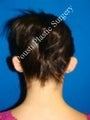 Ear Surgery (Otoplasty)
