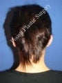 Ear Surgery (Otoplasty)