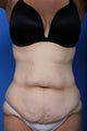 Body Lift