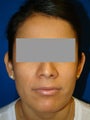 Ear Surgery (Otoplasty)
