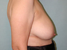 Breast lift