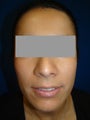 Ear Surgery (Otoplasty)