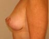Mastopexy (Breast Lift)