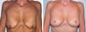 Breast Lift