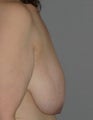 Breast Lift