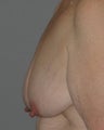 Breast augmentation with Lift