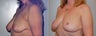 Breast Lift