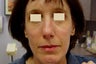 Fraxel Restore Treatment of Acne Scarring