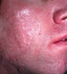 Acne Scarring