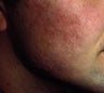 Acne Scarring