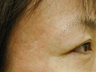 Acne Scars