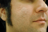CO2 Affirm - Acne Scars