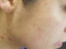 Severe Acne - Photodynamic Treatment