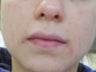 Severe Acne - Photodynamic Treatment
