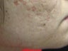 Severe, Deep Acne Scars with Punch Elevation