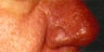 Severe Acne Rosacea