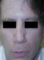 Silicone Microdroplet Therapy for Acne Scars