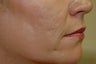Hetter Facial Resurfacing