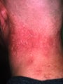 Acne Scarring