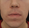 Acne Scarring