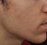 Acne Scarring