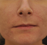 Acne Scarring