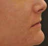 Acne Scarring
