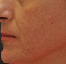 Acne Scarring