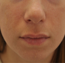 Acne Scarring