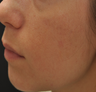 Acne Scarring