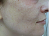 Fractional laser used to treat acne scars
