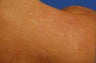 Fraxel Acne Scarring Treatment