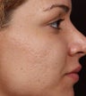 Fraxel ReStore for Acne Scarring