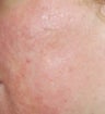 Acne Scar Vitalizer Treatment
