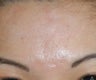 Before and After Acne Scar Treatment with Subcision and cO2 Laser Resurfacing